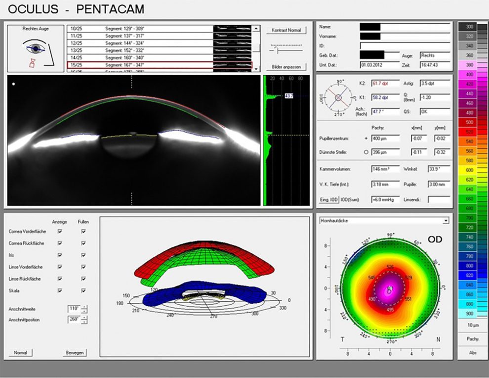 Hornhautpachymetrie bei Keratokonus