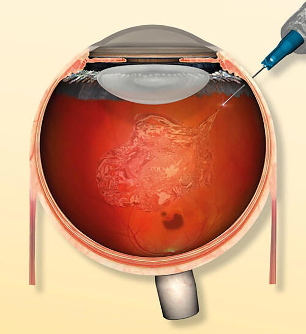 Intravitreale Injektion