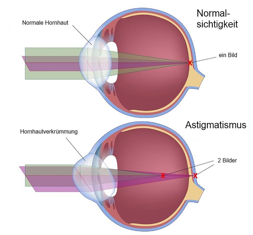 Astigmatismus