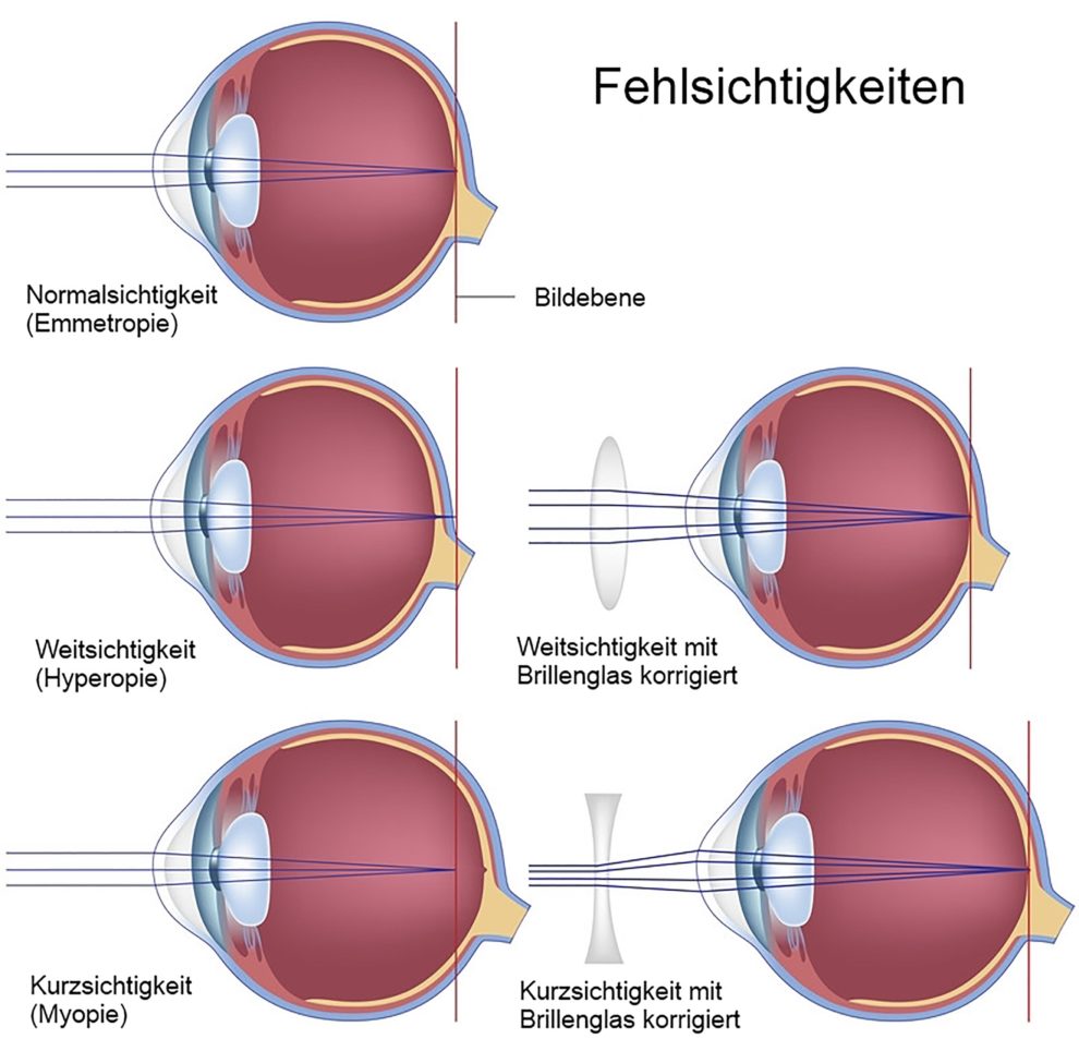 Fehlsichtigkeiten