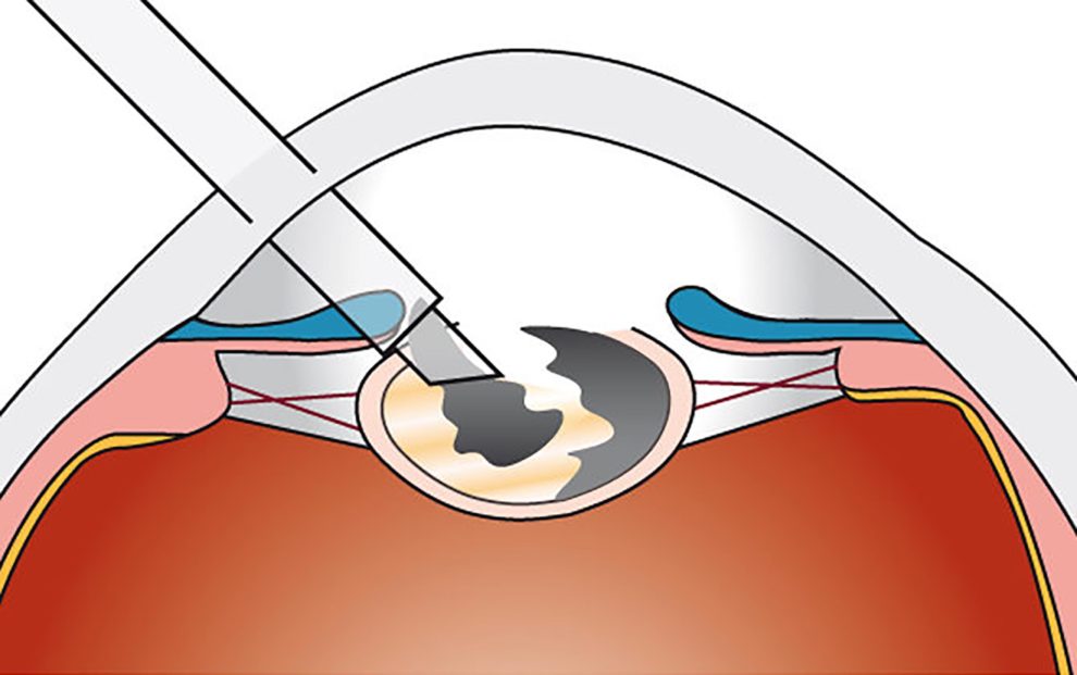 Verflüssigung (Phakoemulsifikation) und Absaugen der Linse