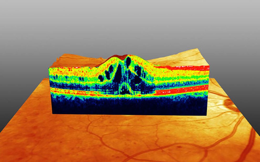 OCT Color Diabetisches Makulaoedem