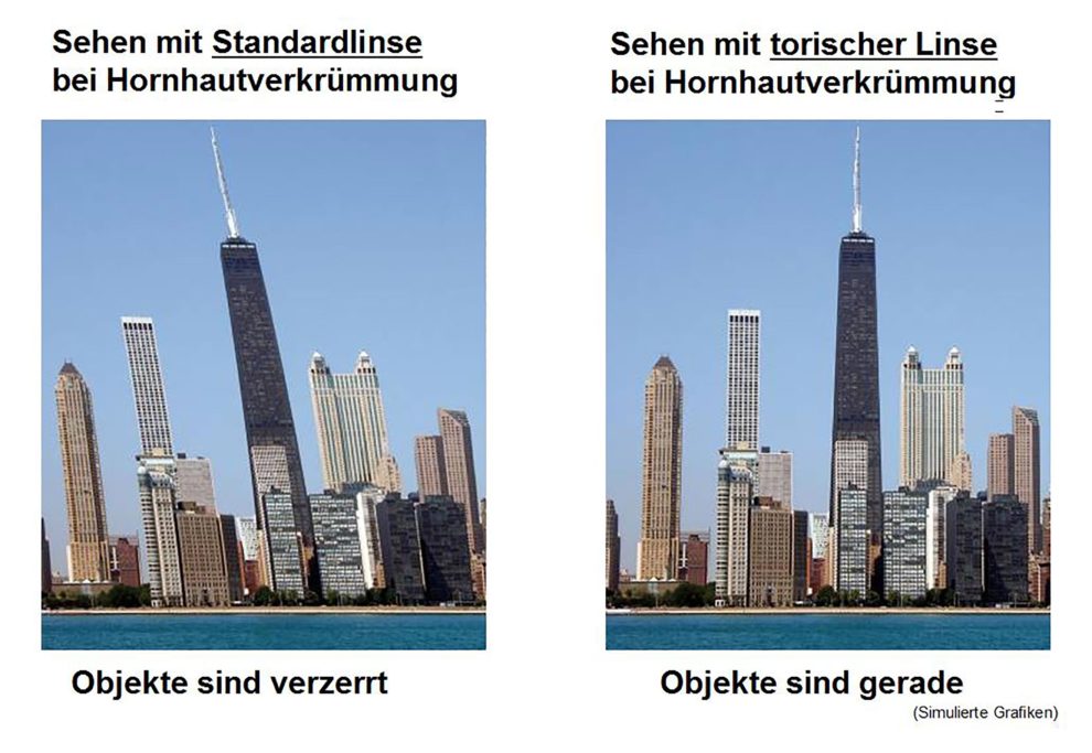 Premiumlinsen Torische Linsen Hornhautverkrümmung