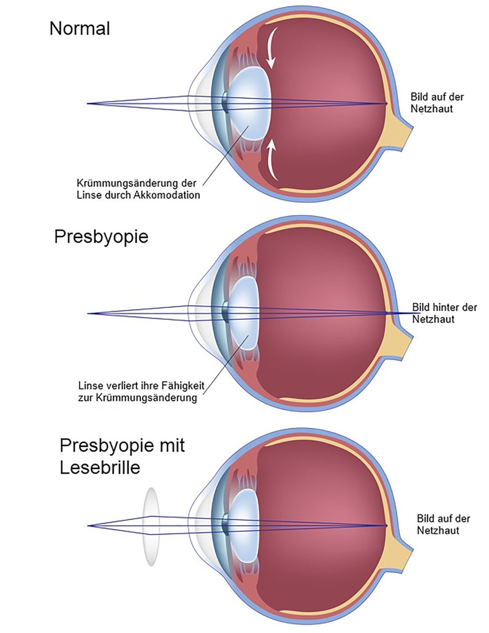 Presbyopie