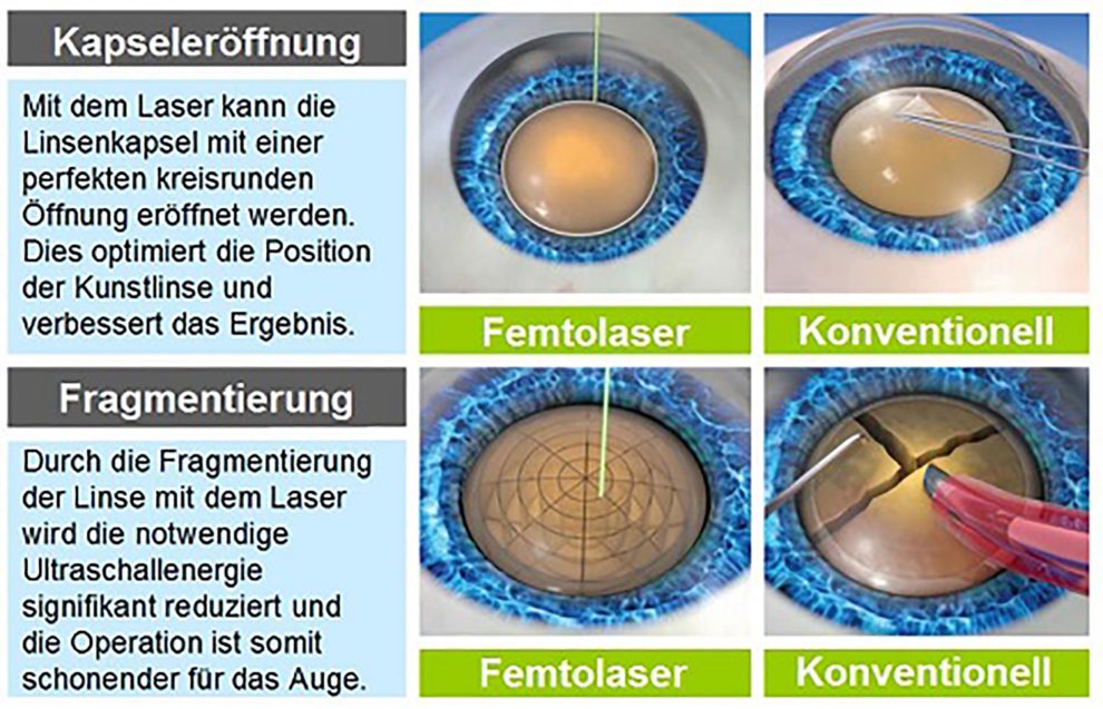 Kataraktoperation mit Laser