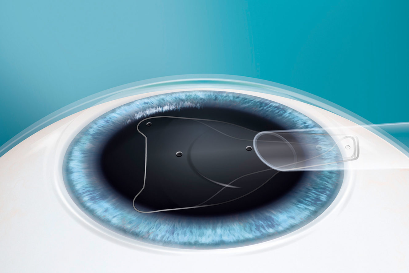 Einsatz der implantierbaren Kontaktlinse EVO Visian ICL (auch Phake-Linse)